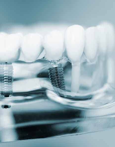 a hand sculpting a dental bridge