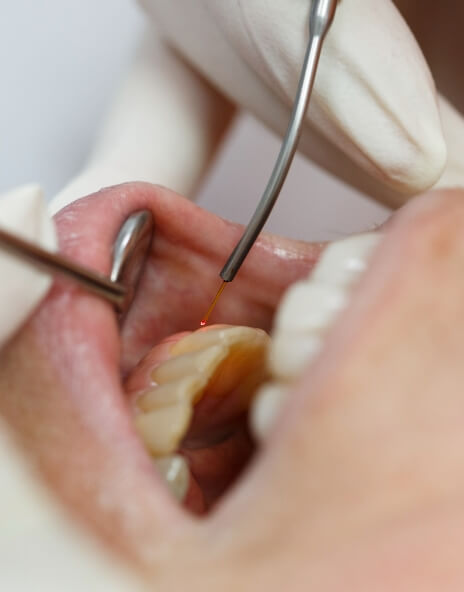 Close up of dentist treating gums with dental laser