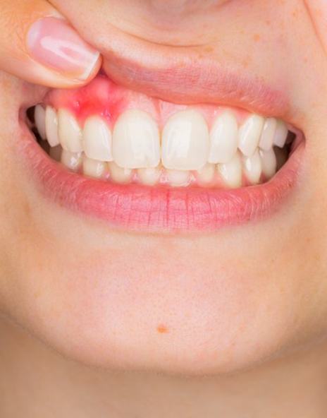 Closeup of patient revealing red gums with gum disease in Arlington