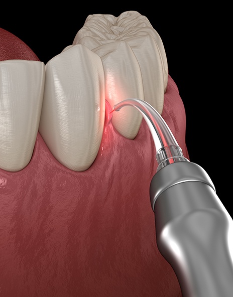 Digital illustration of laser gum disease treatment in Arlington