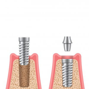 Illustration of dental implant parts