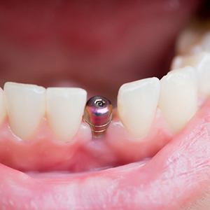 New dental implant in gum?