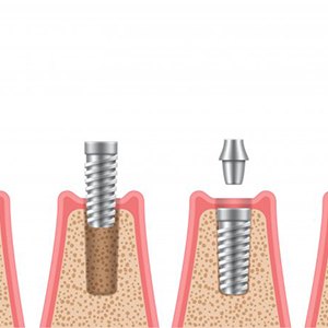 Steps of placing a dental implant