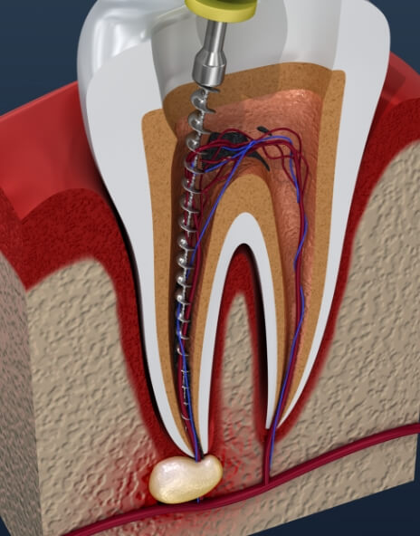 Illustrated dental instrument cleaning inside of tooth during root canal treatment
